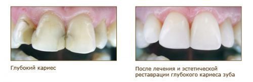 Лечение кариеса пломбированием зубов