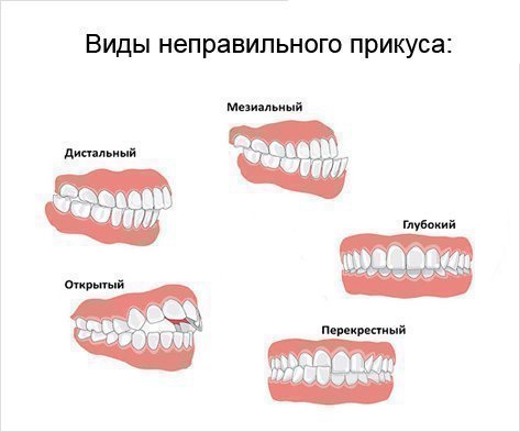 Неправильный прикус - виды