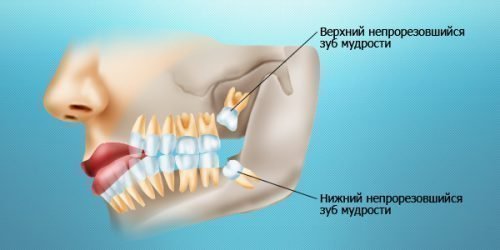 Непрорезавшиеся зубы мудрости