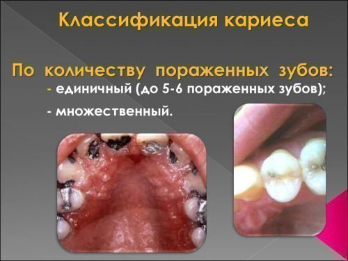Виды по количеству поражений зубов