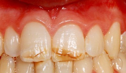 Глубокие горизонтальные трещины на зубах