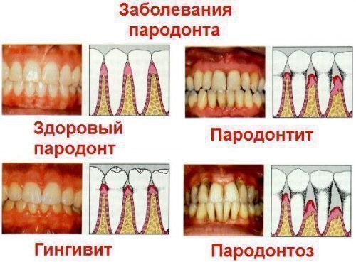 Заболевания пародонта - фото и схема