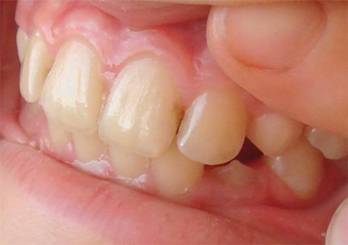 Межзубный кариес затрагивает 2 зуба
