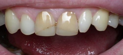 Наклонные трещины на зубах