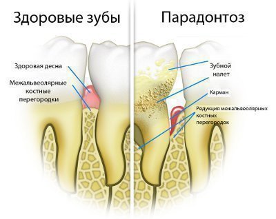 Здоровые десна и пародонтоз