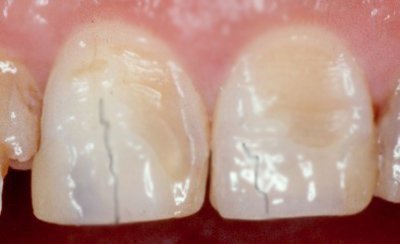Трещины и эрозия эмали зубов после брекетов