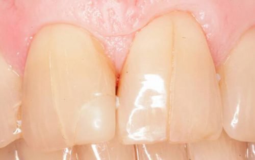 Вертикальные трещины на зубах