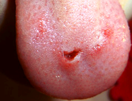 Травмы языка и слизистой - причина запаха крови во рту