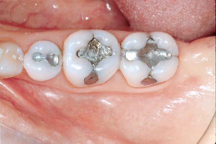 Амальгамные пломбы в зубах