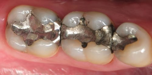 Амальгамные пломбы в зубах