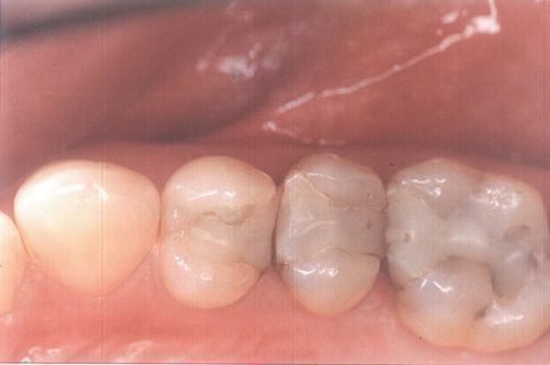 Пластмассовые пломбы в зубах