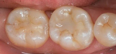 Стеклоиономерные пломбы в зубах