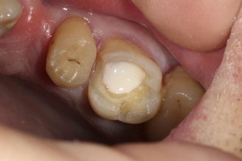 Стеклоиономерная цементная пломба в зубе