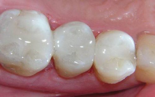 Светополимерные пломбы в зубах