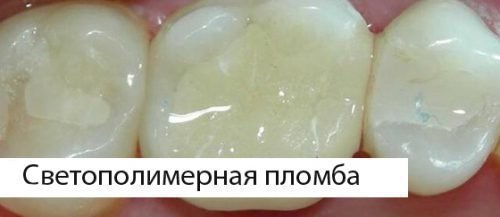 Светополимерная пломба в зубе