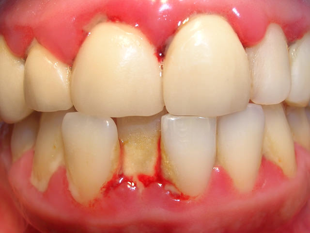 Воспаление десен и зубов