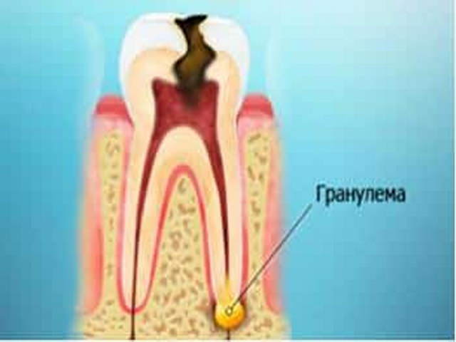 Гранулема заболевание зуба