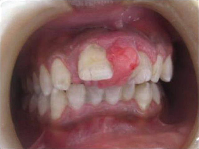 Гранулема зуба? — немедленно к врачу