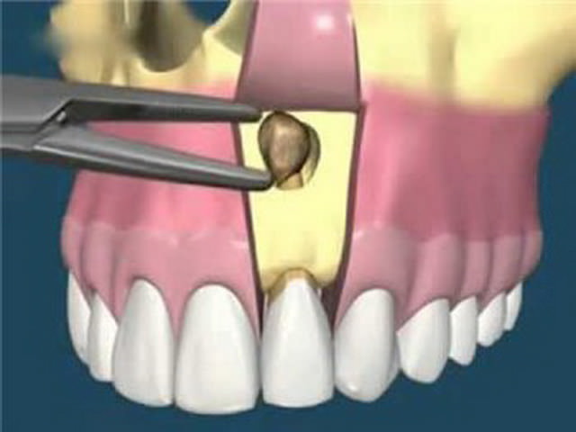 Удаление тела зуба