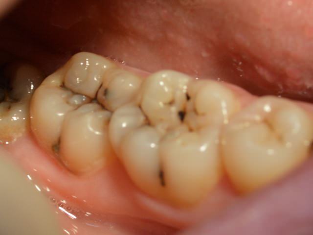 Зубы, пораженные поверхностным кариесом