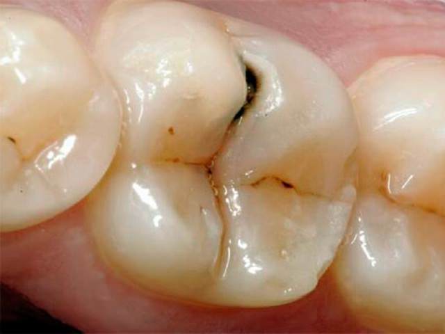 Поверхностный кариес на внешней стороне зуба