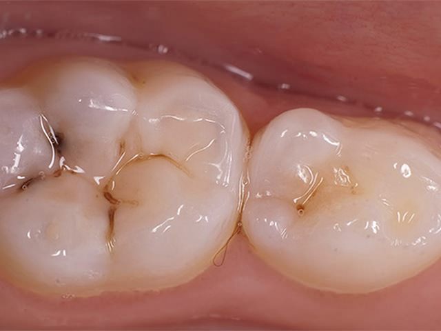 Кариес поверхностный на зубах