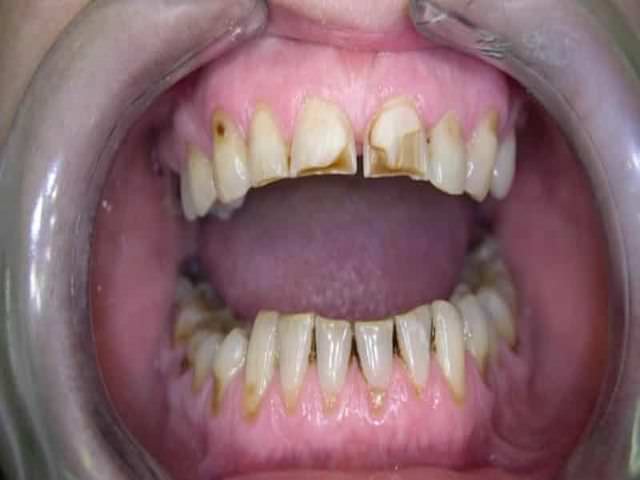 болезнь зубов