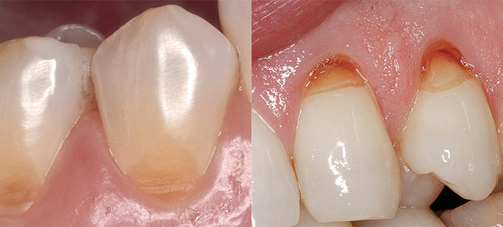 Подробно о причинах возникновения и лечении клиновидного дефекта зубов