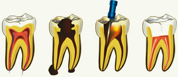 Как удаляют нерв из зуба, особенности и последствия