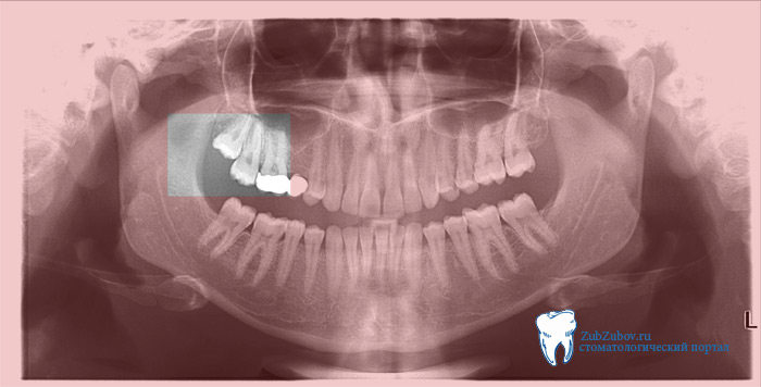 Прорезывающийся зуб мудрости фото