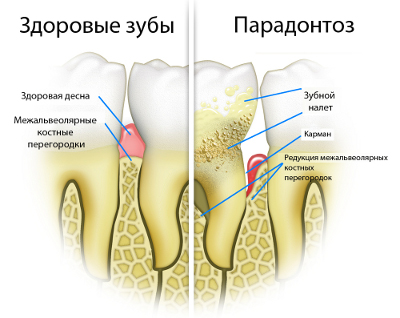 Пародонтоз пародонтоз