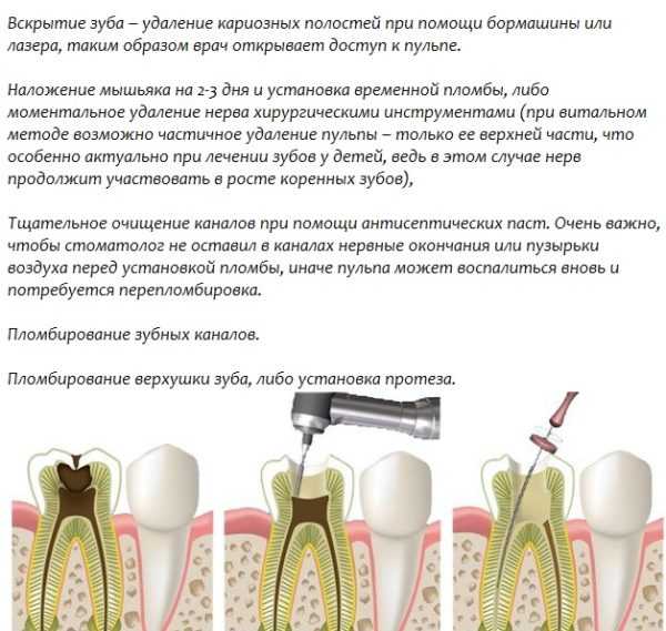 Удаление нерва зуба схема