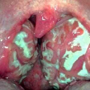Ангина фото горла: посмотрим, как оно выглядит и что с ним происходит во время болезни