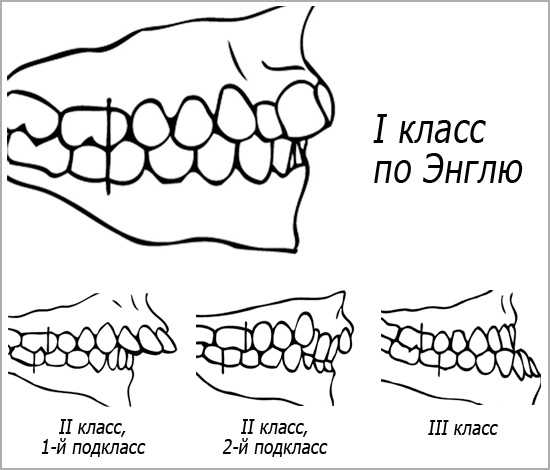 Классы окклюзии. Классификация аномалий прикуса Энгля. Второй класс классификации аномалий прикуса по Энглю. Классификация зубочелюстных аномалий по Энглю. Классификация Энгля в ортодонтии.