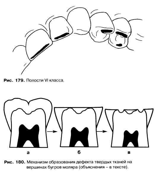 Блэк полости зуба. Классификация кариозных полостей Блэка.. Кариес зубов классификация кариозных полостей по Блэку. Классификация Блэка кариес. Препарирование кариозных полостей 6 класса.