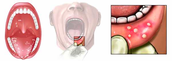 Болит язык сбоку - причины, чем лечить, у основания, можно ли принимать трахисан, белый прыщ, фото